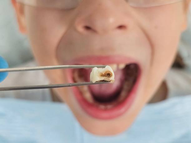 Best Broken or Cracked Tooth Emergency Dentist in Berwick, PA